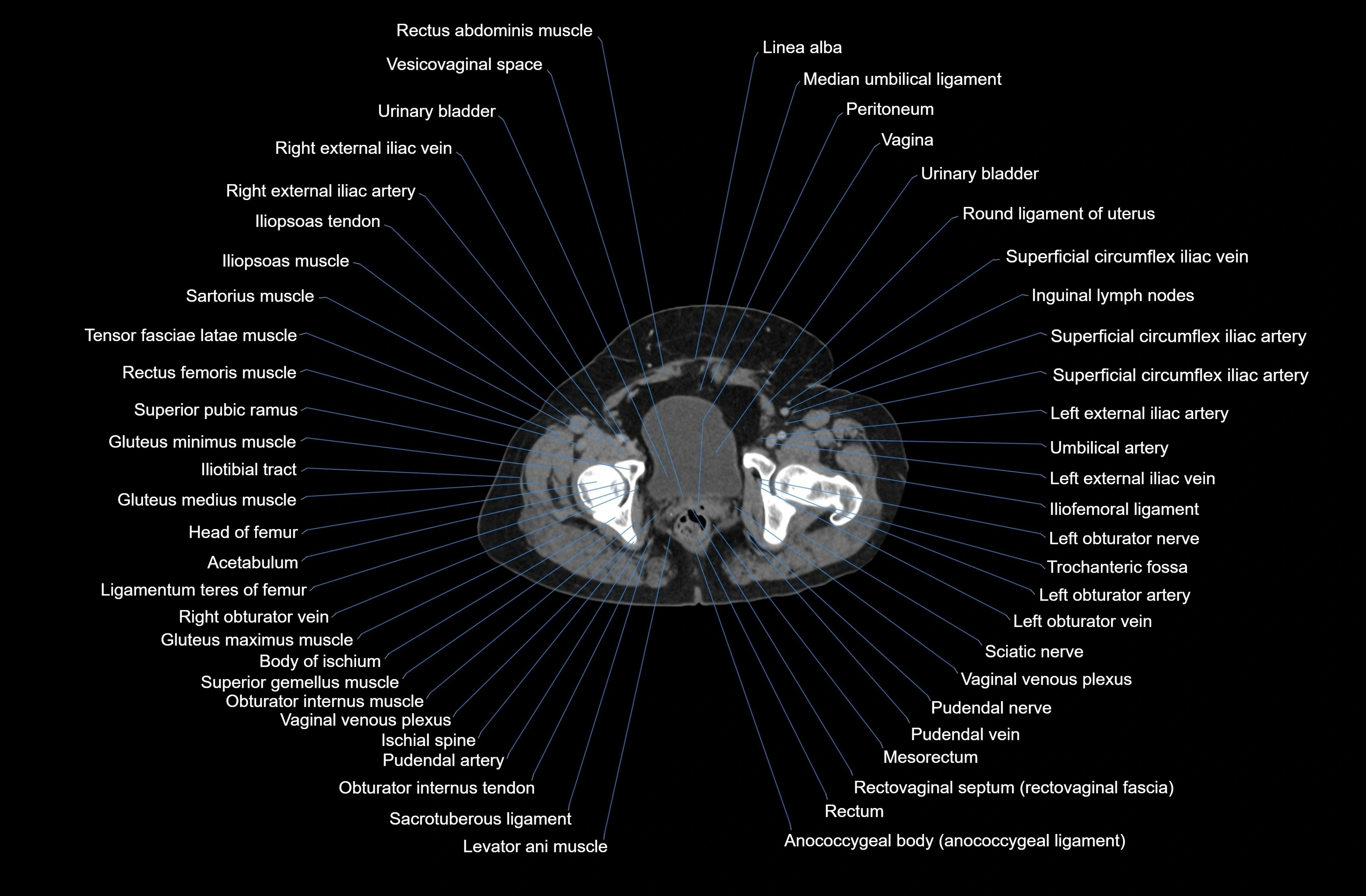 CT Abdomen axial cross sectional anatomy labelled radiology image-00093.webp